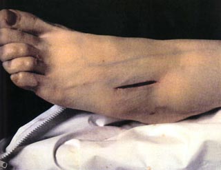 The Morgue Rat poison Suicide II 