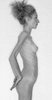 Immagini, l'anoressica sedicenne Bianca