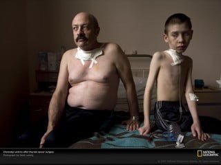 Vittime di Chernobyl dopo intervento chirurgico per rimozione cancro alla tiroide